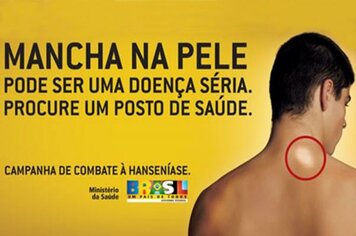 Posto de Saúde promove Campanha de combate à hanseníase